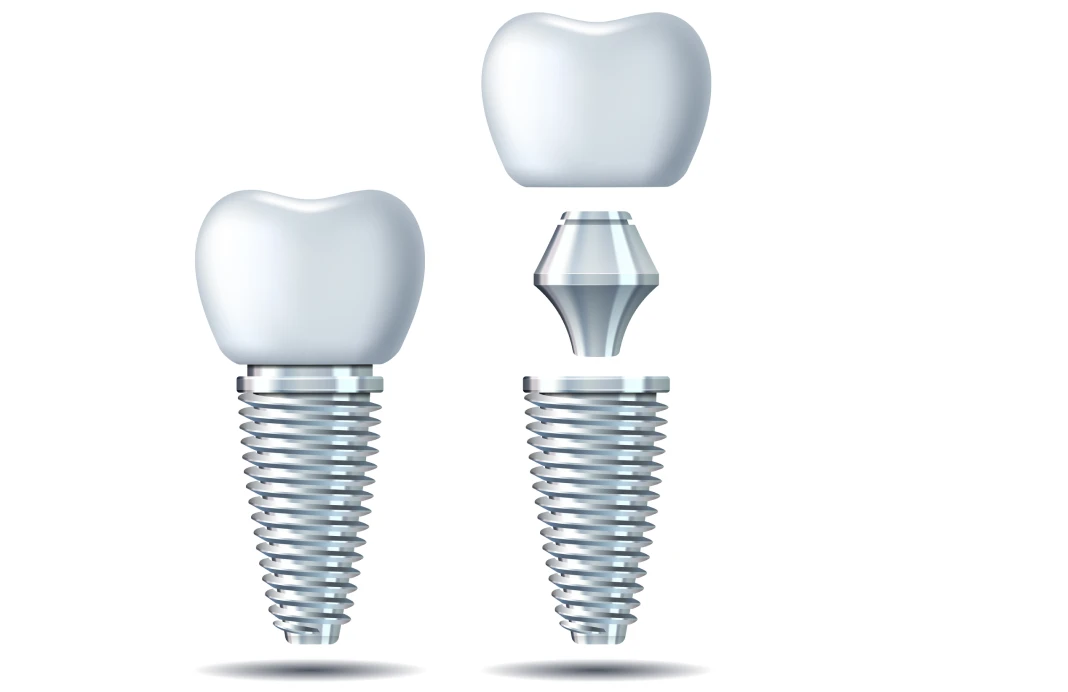 当院のインプラント